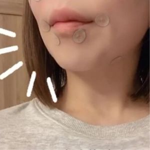 「美容サロンやめる人続出…」貼るだけケア美容鍼が炎上中！？